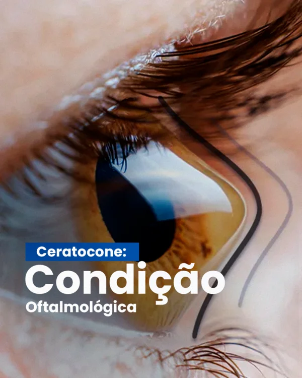 ceratocone